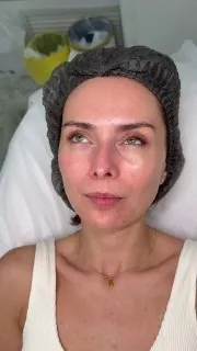 👁Армирование орбиты - это НЕ заполнение носослезной борозды.
