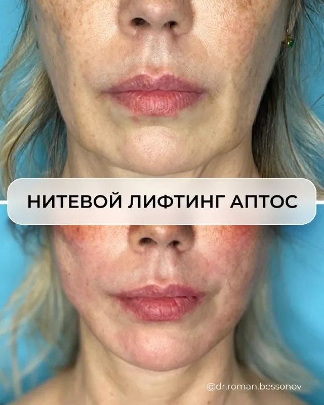 Нитевой лифтинг Аптос