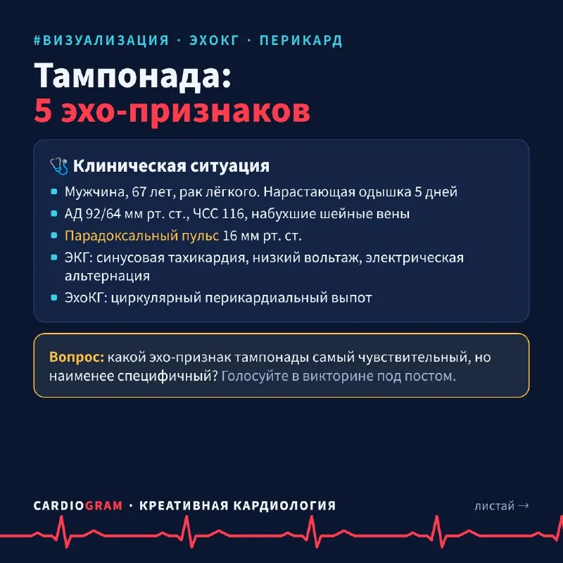 🫀 Тампонада сердца: 5 эхо-признаков за одну карусель